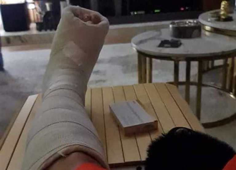 "اشتقنا لك يا جبس".. إصابة نجلاء بدر بكسر في القدم - صورة 1