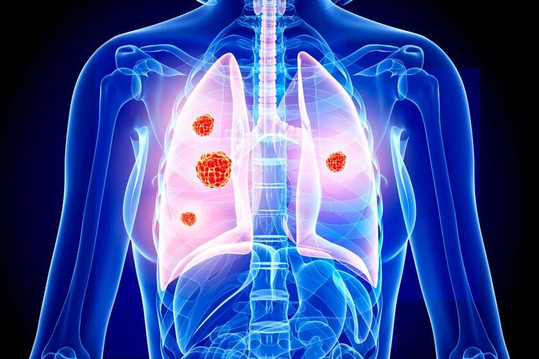 مراحل سرطان الرئة سرطان الرئة