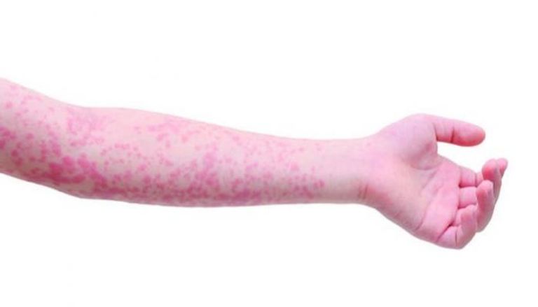 الطفح الجلدي من أبرز أعراض الحمى القرمزية