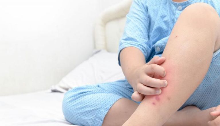 الطفح الجلدي من أبرز أعراض الحمى القرمزية