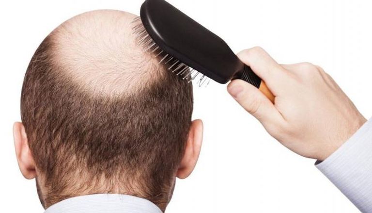  تساقط الشعر قد يرجع إلى أسباب عضوية - أرشيفية