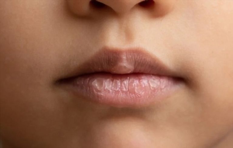 البرودة تصيب الشفاه بالجفاف والتشقق