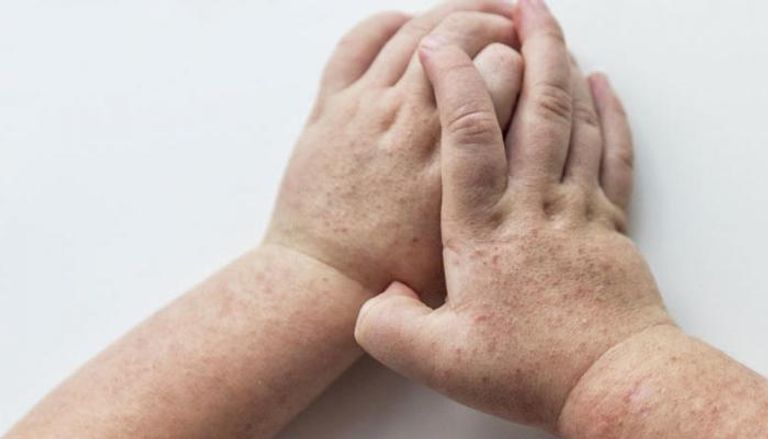 الحمى القرمزية نادرا من تسبب الوفاة