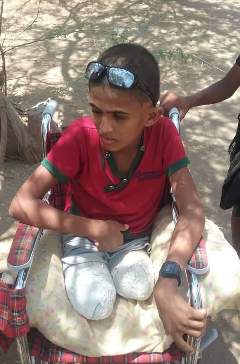 سعيد فقد قدمه ويده بفعل ألغام الحوثي