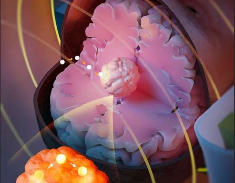 البذرة المغناطيسية تصل للأماكن التي يصعب الوصول لها بالجراحة التقليدية