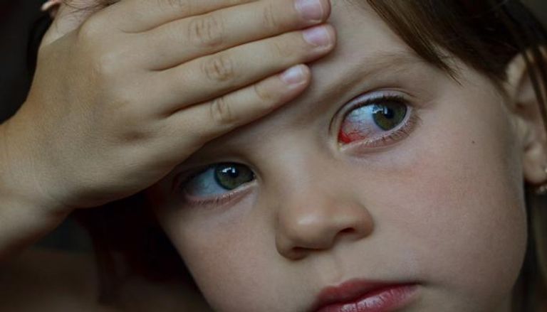 ضعف المناعة يجعل الأطفال أكثر عرضة لالتهاب ملتحمة العين - أرشيفية