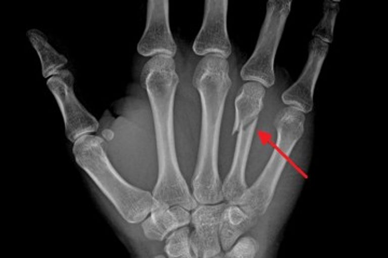 تقنية لقاحات "الرنا مرسال" توفر حلا مثاليا لكسور العظام
