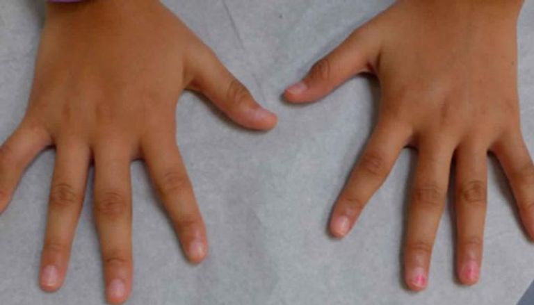 تورم الأصابع من أعراض الالتهاب المفصلي الروماتويدي