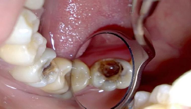 علاج التهاب لب الأسنان يختلف حسب شدة الإصابة