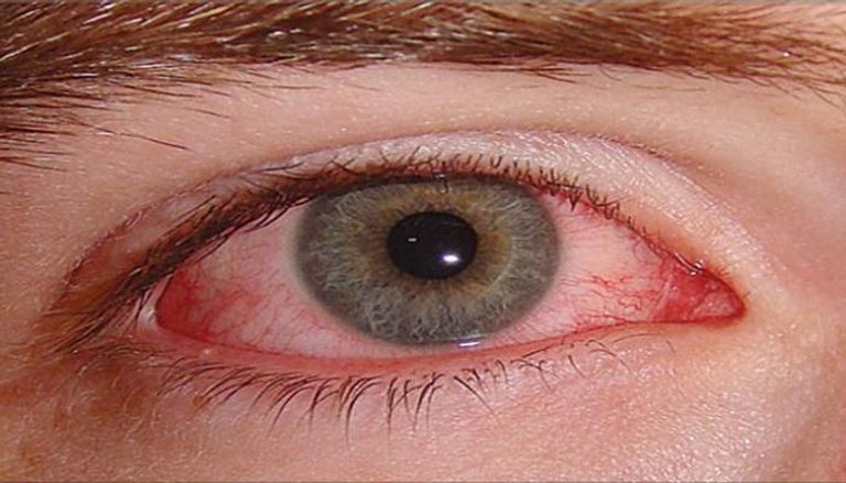 الاحمرار من أبرز أعراض ارتفاع ضغط العين