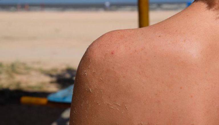 التشخيص المبكر يرفع فرص نجاح علاج سرطان الجلد