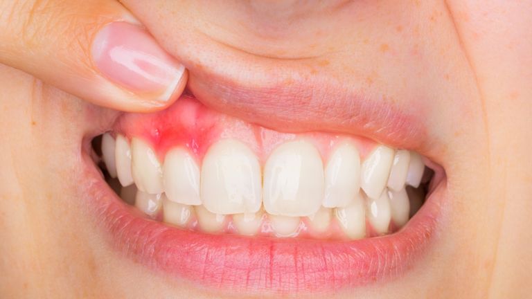 غسل الأسنان بعنف يؤدي إلى انحسار اللثة- أرشيفية