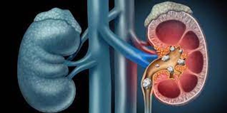 حصوات الكلى- أرشيفية