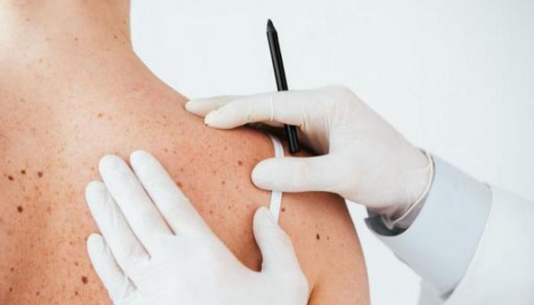 التشخيص المبكر يرفع فرص نجاح علاج سرطان الجلد