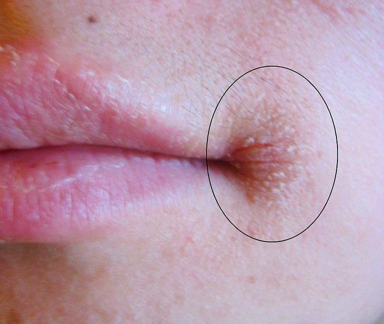 أعراض نقص الفيتامينات