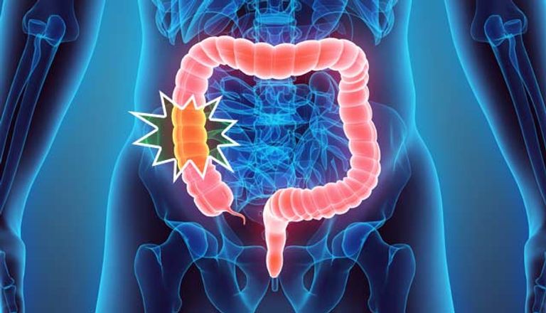 أعراض الإصابة بسرطان الأمعاء