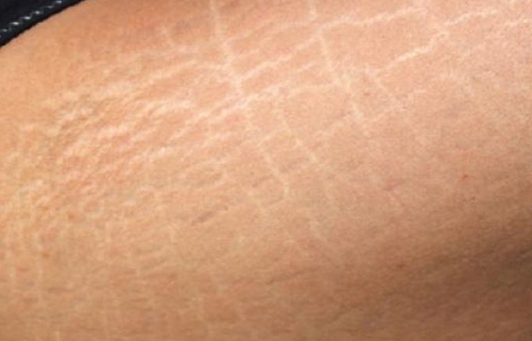 طرق فعالة لمحاربة السيلوليت