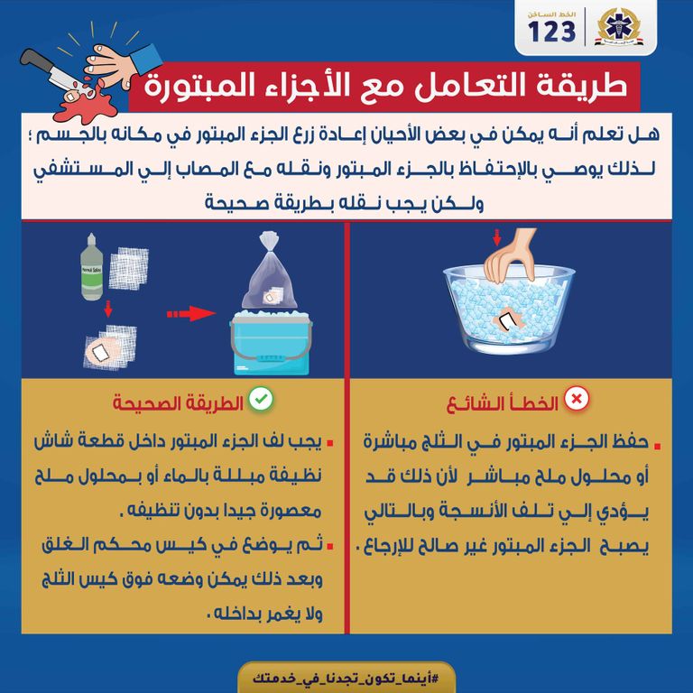 هناك خطوات محددة للتعامل مع الإصبع المبتور - تعبيرية