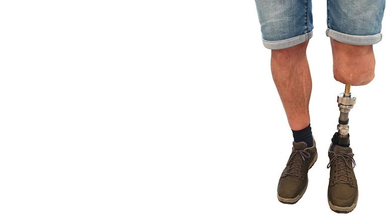 هناك خطوات محددة للتعامل مع الإصبع المبتور - تعبيرية