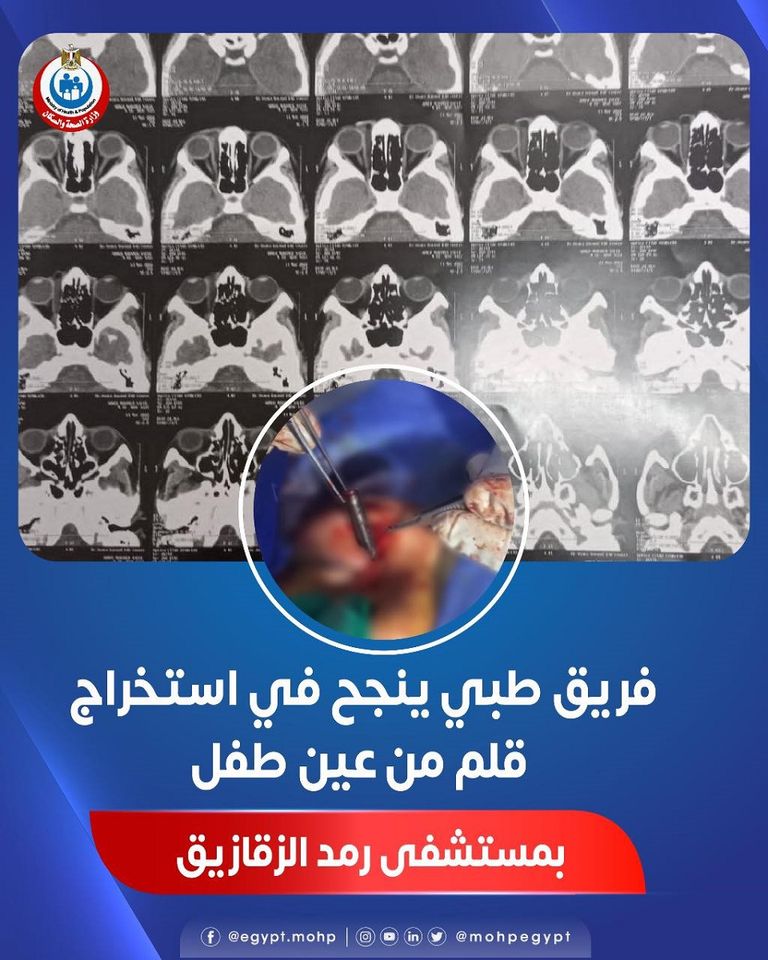أشعة تكشف حالة الطفل المصاب
