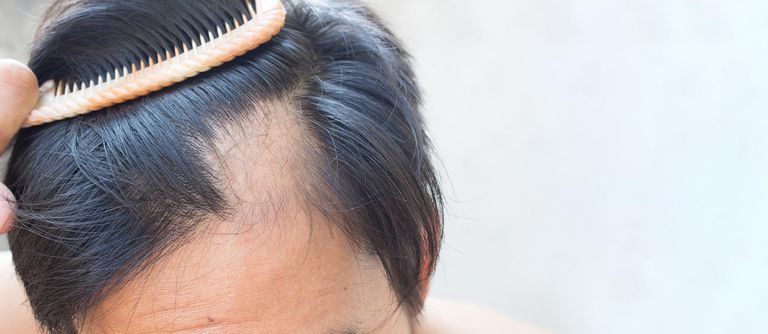 داء الثعلبة يؤثر على فروة الرأس