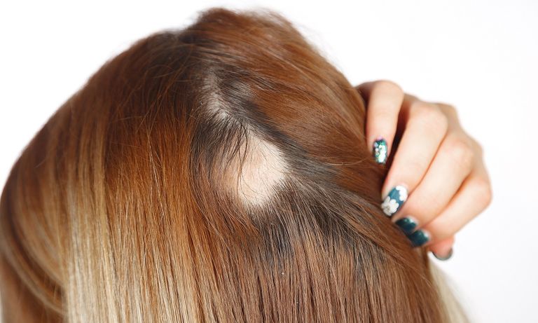 داء الثعلبة يؤثر على فروة الرأس