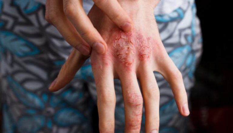 التهاب الجلد التأتبي ينتج عنه حكة واحمرار وانتفاخ على سطح الجلد