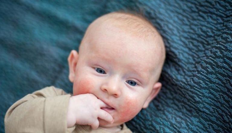 حساسية اللاكتوز عند الرضع