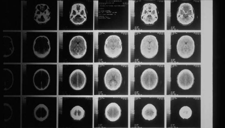 أشعة لورم في المخ من الدرجة الأولى 