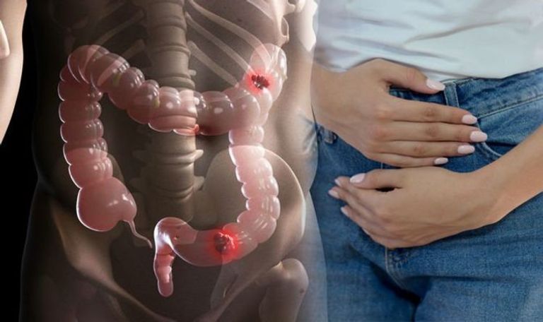 أعراض سرطان الأمعاء تتشابه مع أمراض أخرى