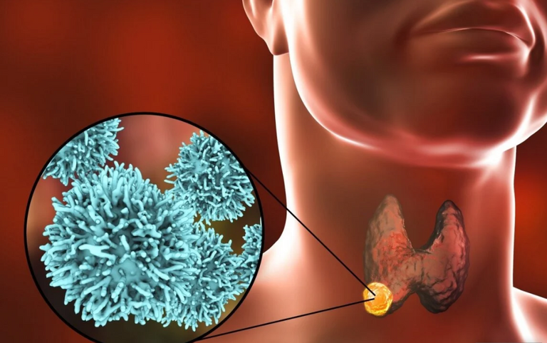 أسباب سرطان الحلقوم