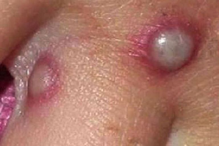 شخص مصاب بفيروس جدري القرود