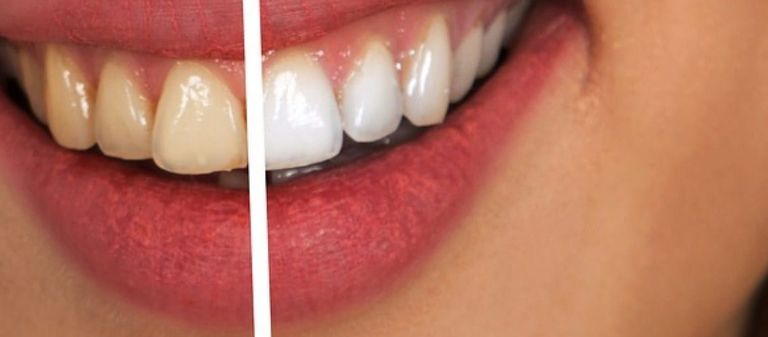مقارنة بين أسنان جرى تبييضها وأخرى لا