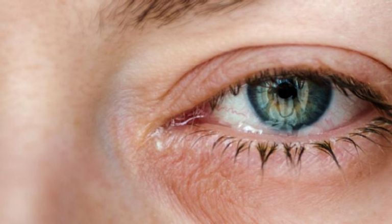 الضمور البقعي أحد أكثر أسباب العمى شيوعا 