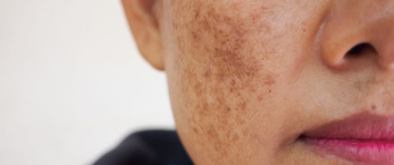 البقع الصبغية تؤثر على الجمال - أرشيفية