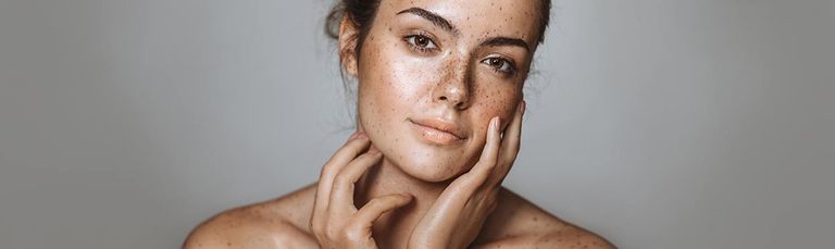 البقع الصبغية تؤثر على الجمال - أرشيفية