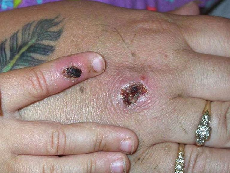 مريض يظهر عليه طفح جلدي أحد أعراض الإصابة بفيروس جدري القرود شخص مصاب بعدوى جدري القرود