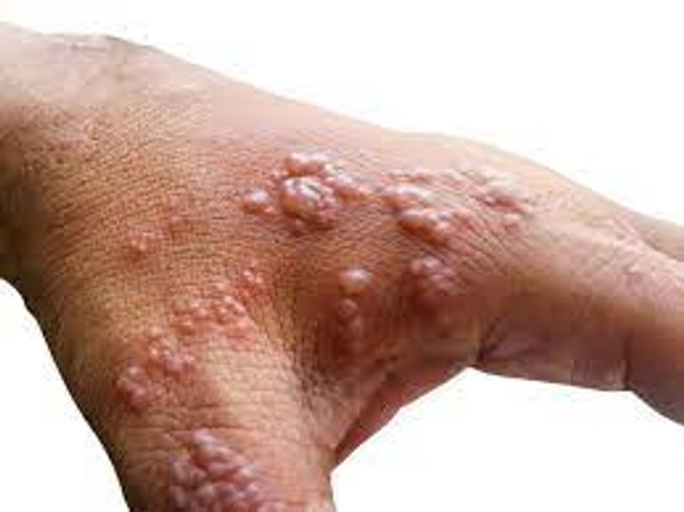 بريطانيا توفر لقاح الجدري مع انتشار جدري القرود بأوروبا- أرشيفية