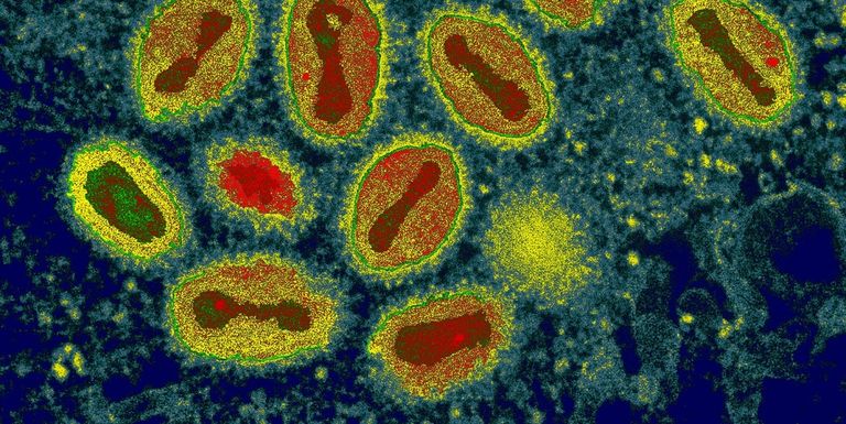 فيروس جدري القرود - أرشيفية