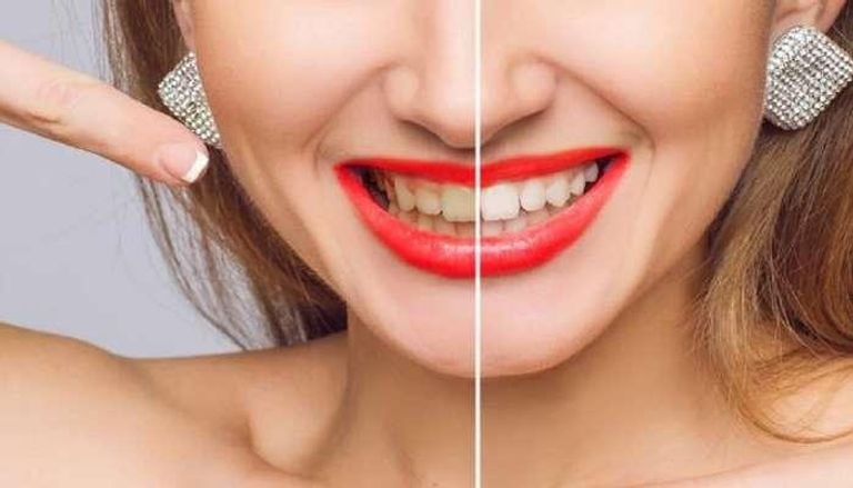 أسباب إصفرار الأسنان تعود لعدة عوامل - تعبيرية