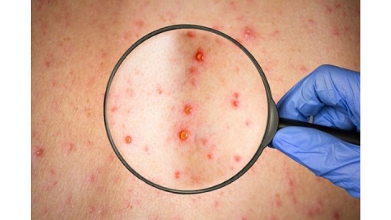 شخص مصاب بجدري القرود - أرشيفية