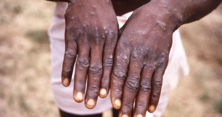 جدري القرود انتشر عبر 12 دولة في العالم