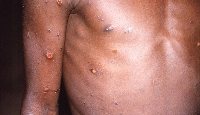 عدوى جدري القرود لا تنتشر بسرعة من كوفيد- 19