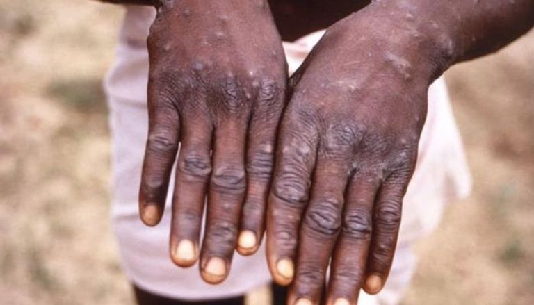 عدوى جدري القرود لا تنتشر بسرعة من كوفيد- 19