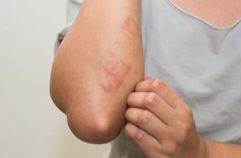 قلق عالمي متصاعد من جدري القرود