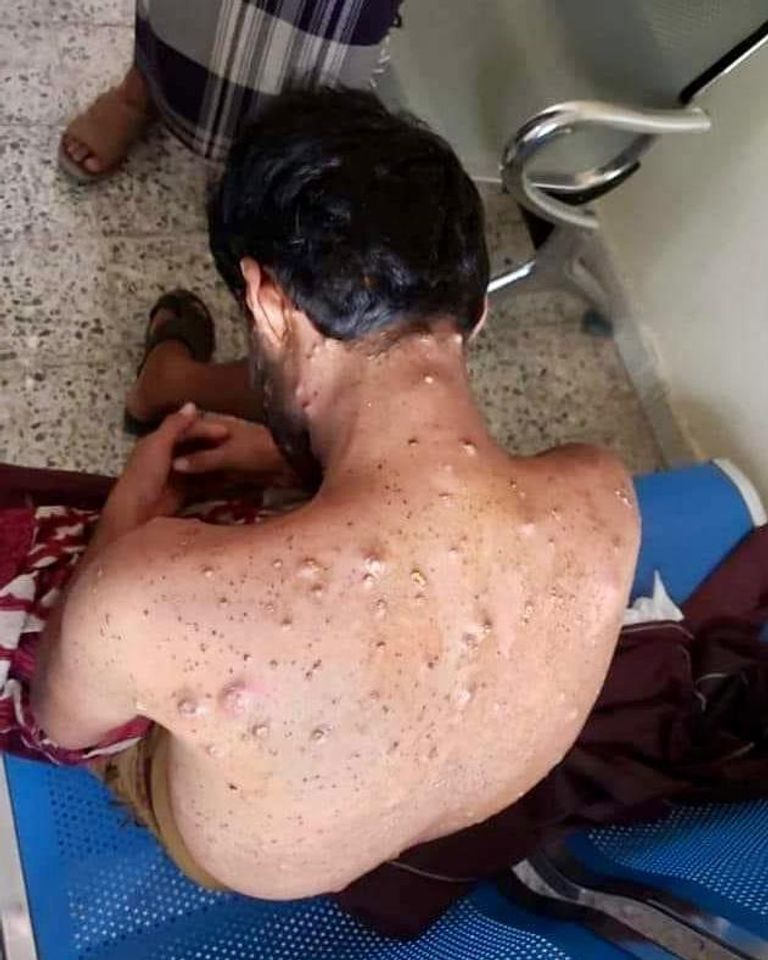 الصحة اليمنية تستنفر أطقمها الطبية بسبب جدري القرود