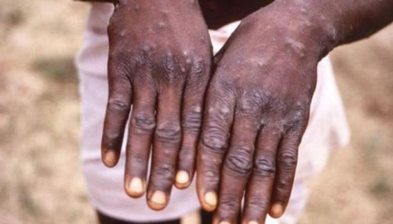 الطفح الجلدي أبرز أعراض جدري القرود