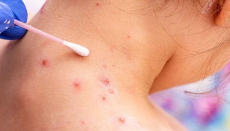 جدري القرود لا ينتشر بسرعة مثل فيروس كورونا