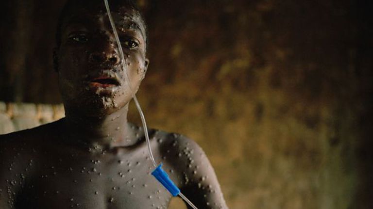 جدري القرود ظهر في 19 دولة حول العالم