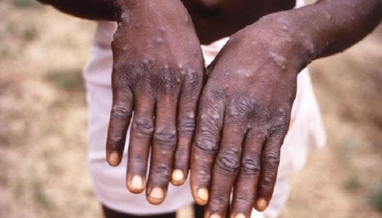 الطفح الجلدي أبرز أعراض الإصابة بجدري القرود
